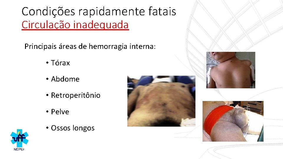 Condições rapidamente fatais Circulação inadequada Principais áreas de hemorragia interna: • Tórax • Abdome