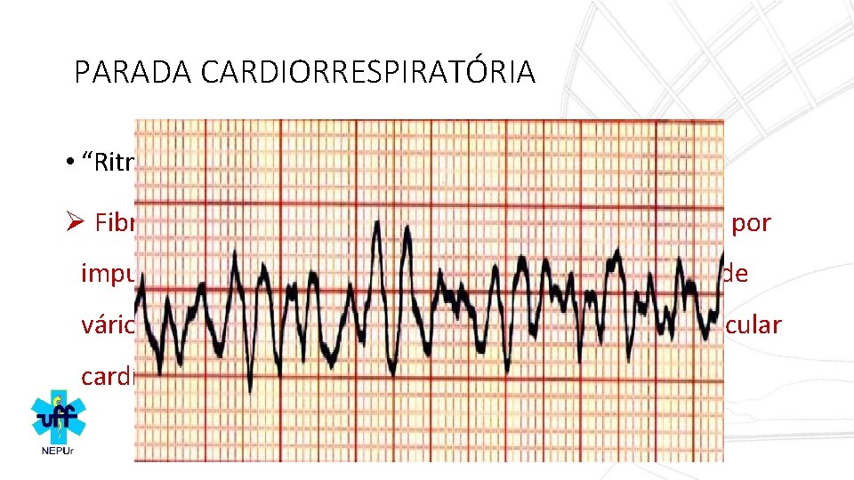 PARADA CARDIORRESPIRATÓRIA • “Ritmo” Cardíaco durante a PCR: Ø Fibrilação Ventricular - arritmia cardíaca