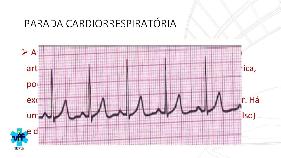 PARADA CARDIORRESPIRATÓRIA Ø Atividade elétrica sem pulso (AESP) – Ausência de pulso arterial detectável