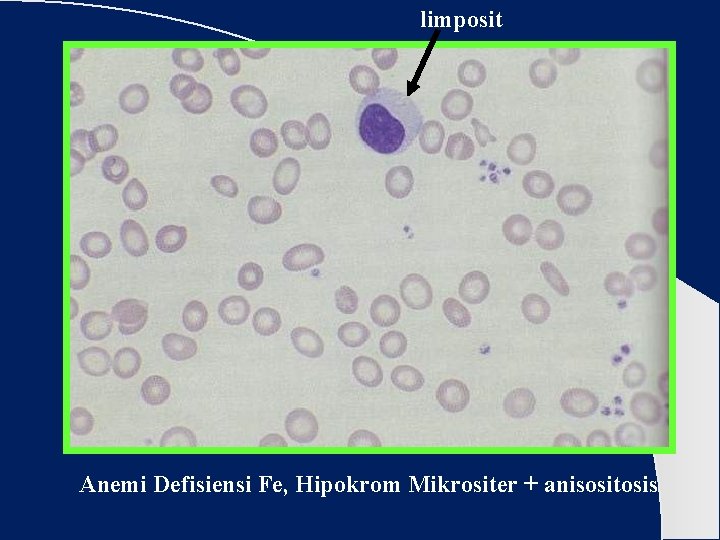 limposit Anemi Defisiensi Fe, Hipokrom Mikrositer + anisositosis 