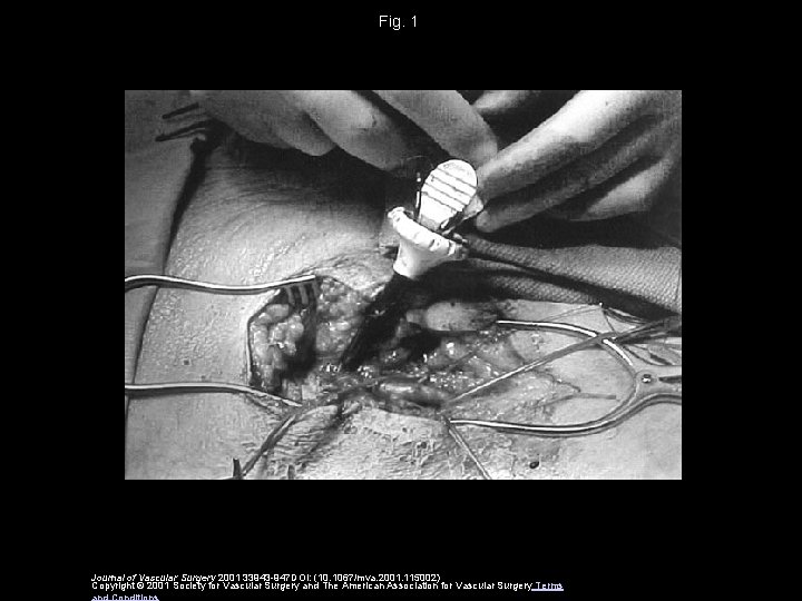 Fig. 1 Journal of Vascular Surgery 2001 33943 -947 DOI: (10. 1067/mva. 2001. 115002)