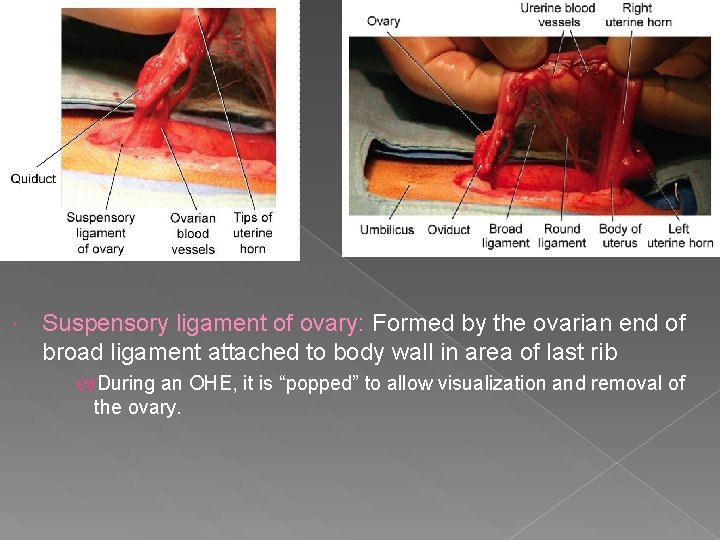  Suspensory ligament of ovary: Formed by the ovarian end of broad ligament attached