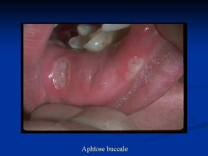 Aphtose buccale 