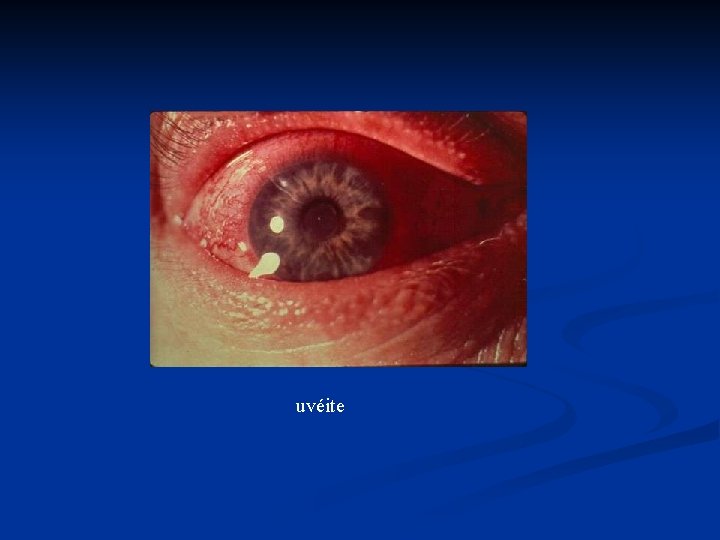 uvéite 