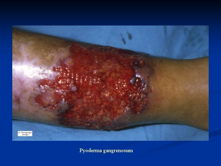 Pyoderma gangrenosum 