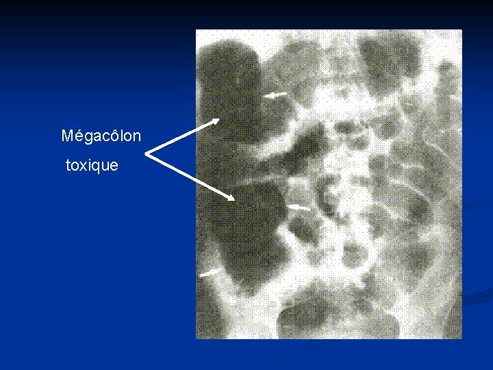 Mégacôlon toxique 