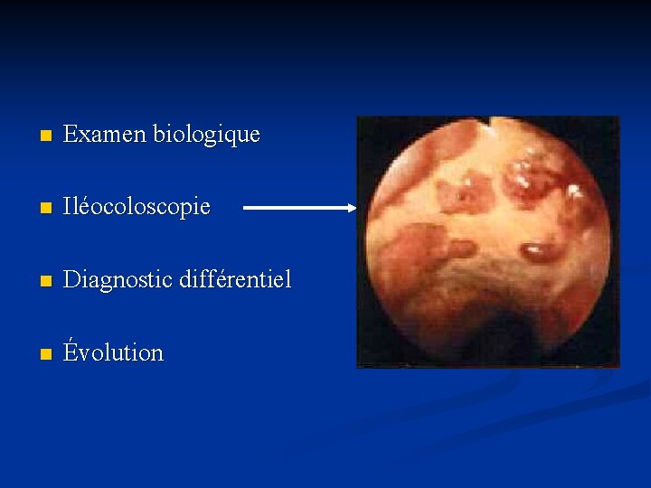 n Examen biologique n Iléocoloscopie n Diagnostic différentiel n Évolution 