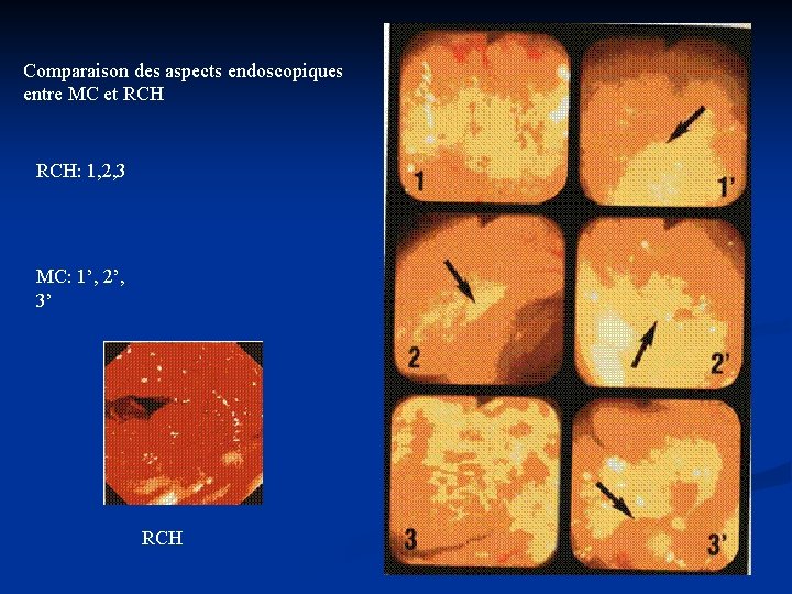 Comparaison des aspects endoscopiques entre MC et RCH: 1, 2, 3 MC: 1’, 2’,