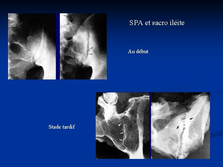 SPA et sacro iléite Au début Stade tardif 