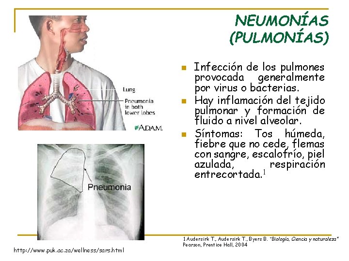 NEUMONÍAS (PULMONÍAS) n n n http: //www. puk. ac. za/wellness/sars. html Infección de los