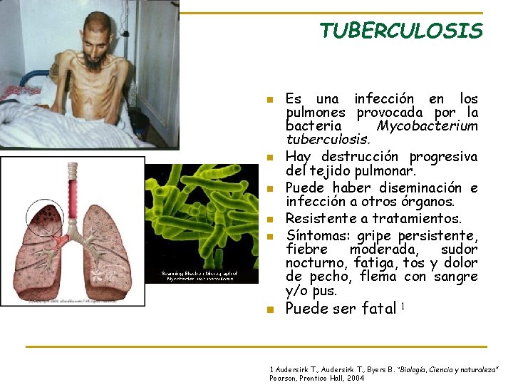 TUBERCULOSIS n n n Es una infección en los pulmones provocada por la bacteria
