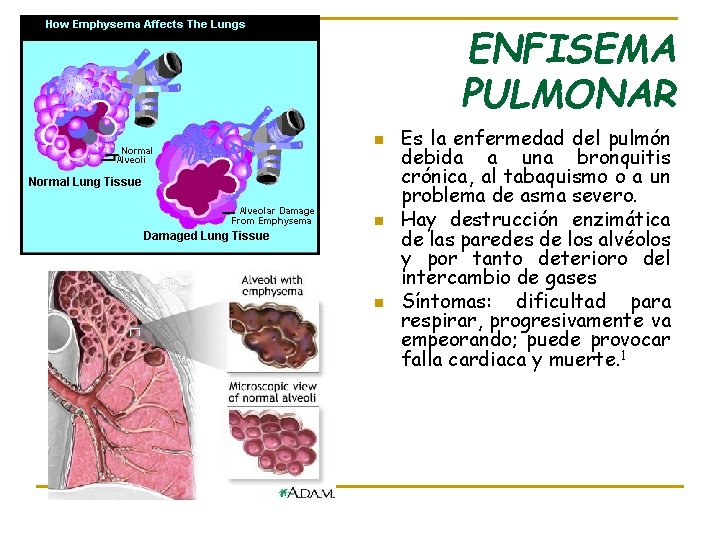 ENFISEMA PULMONAR n n n Es la enfermedad del pulmón debida a una bronquitis
