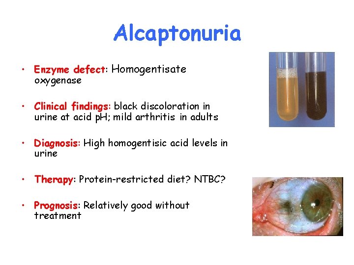 Alcaptonuria • Enzyme defect: Homogentisate oxygenase • Clinical findings: black discoloration in urine at