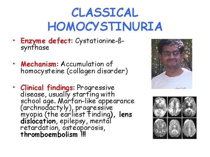 CLASSICAL HOMOCYSTINURIA • Enzyme defect: Cystationine-ßsynthase • Mechanism: Accumulation of homocysteine (collagen disorder) •