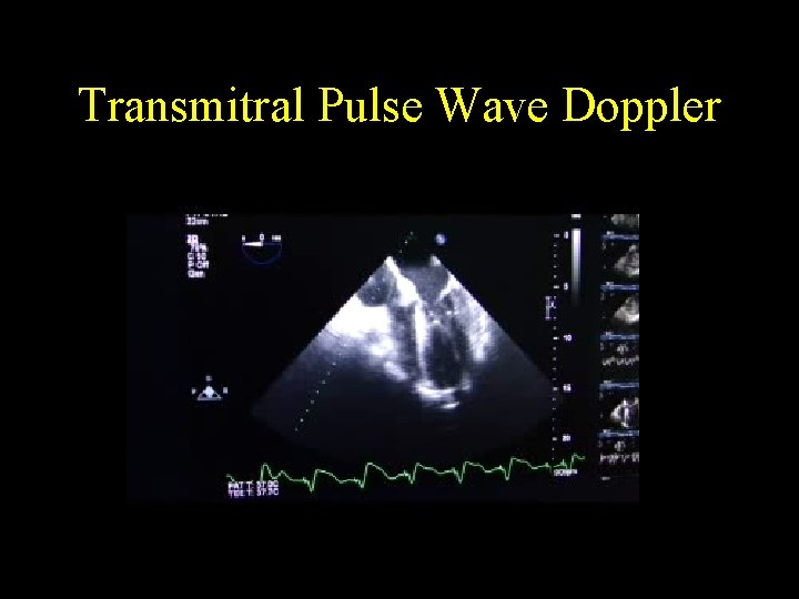 Transmitral Pulse Wave Doppler 