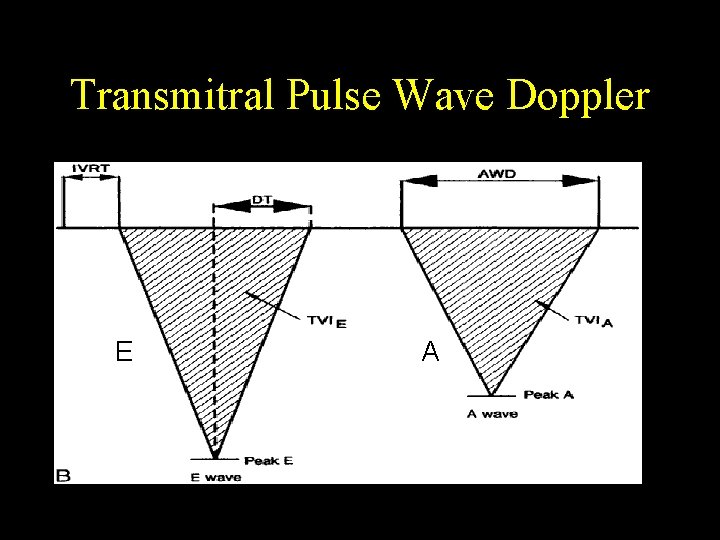 Transmitral Pulse Wave Doppler E A 