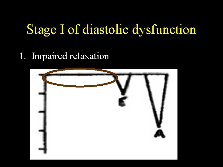 Stage I of diastolic dysfunction 1. Impaired relaxation 