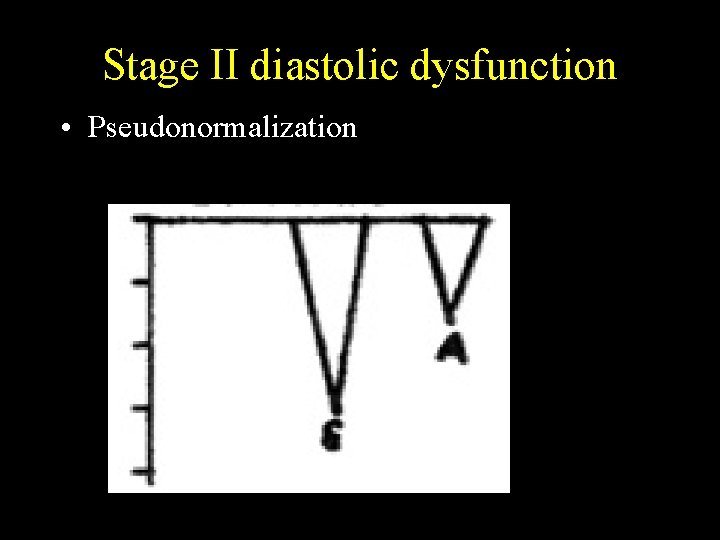 Stage II diastolic dysfunction • Pseudonormalization 