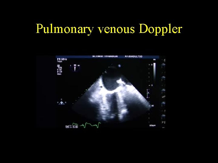Pulmonary venous Doppler 