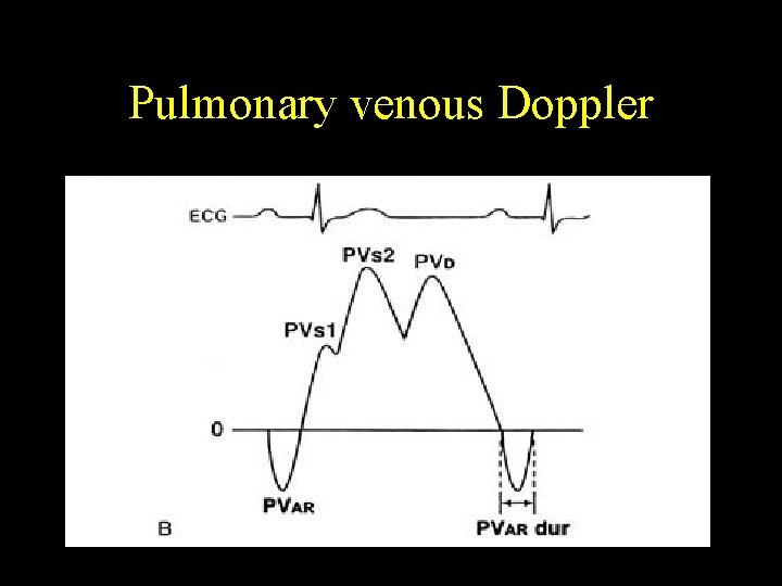 Pulmonary venous Doppler 