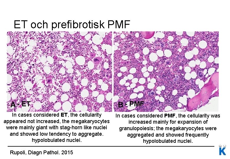 ET och prefibrotisk PMF - ET In cases considered ET, the cellularity appeared not