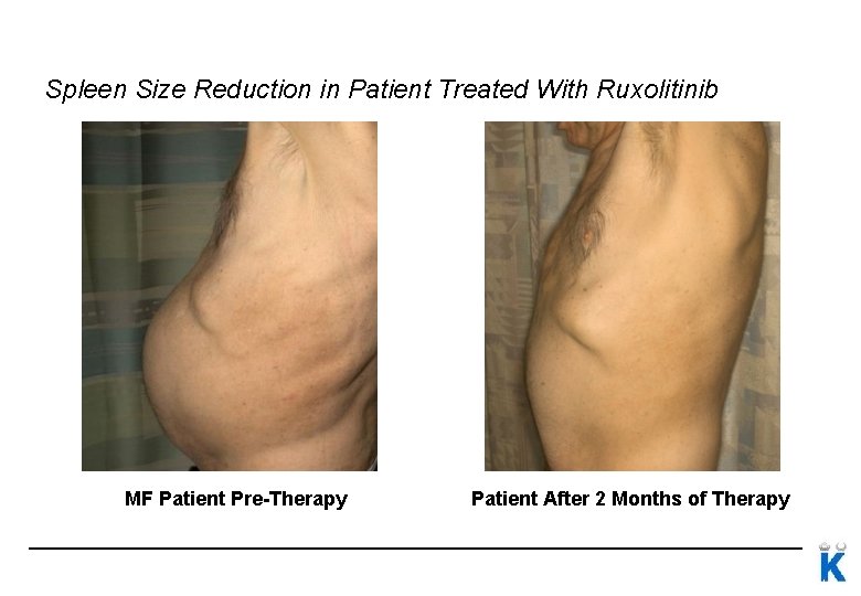 Spleen Size Reduction in Patient Treated With Ruxolitinib MF Patient Pre-Therapy 59 Patient After