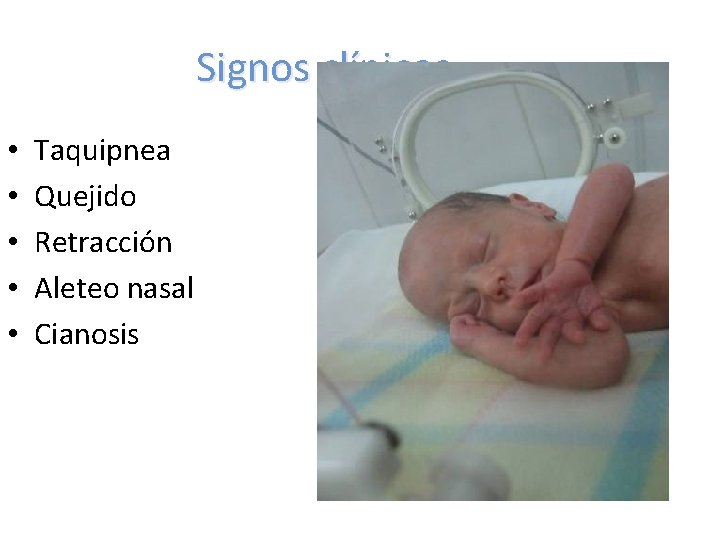 Signos clínicos • • • Taquipnea Quejido Retracción Aleteo nasal Cianosis 