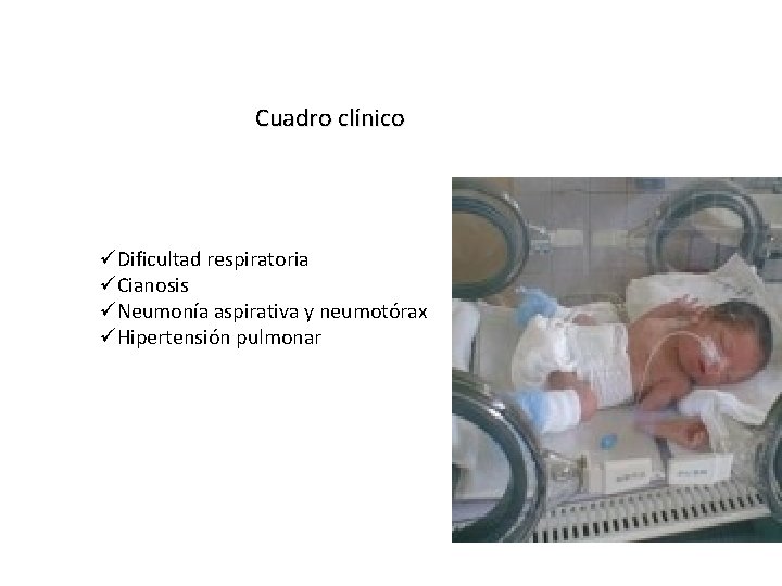 Cuadro clínico üDificultad respiratoria üCianosis üNeumonía aspirativa y neumotórax üHipertensión pulmonar 