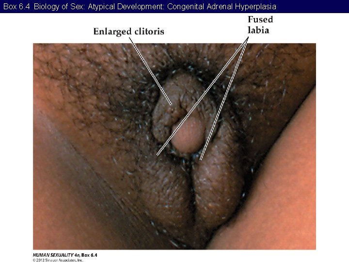 Box 6. 4 Biology of Sex: Atypical Development: Congenital Adrenal Hyperplasia 