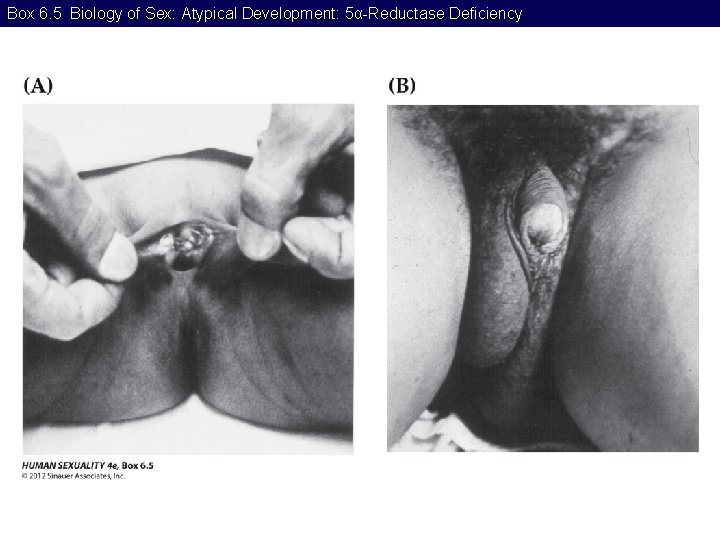 Box 6. 5 Biology of Sex: Atypical Development: 5α-Reductase Deficiency 