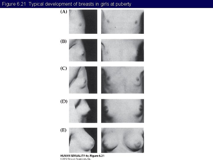 Figure 6. 21 Typical development of breasts in girls at puberty 