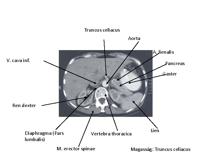 Truncus celiacus Aorta A. lienalis V. cava inf. Pancreas Gaster Ren dexter Diaphragma (Pars Truncus celiacus Aorta A. lienalis V. cava inf. Pancreas Gaster Ren dexter Diaphragma (Pars