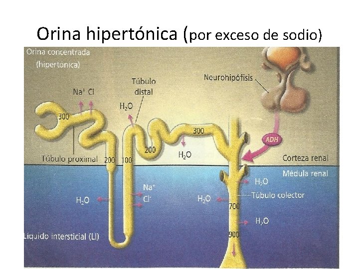 Orina hipertónica (por exceso de sodio) 