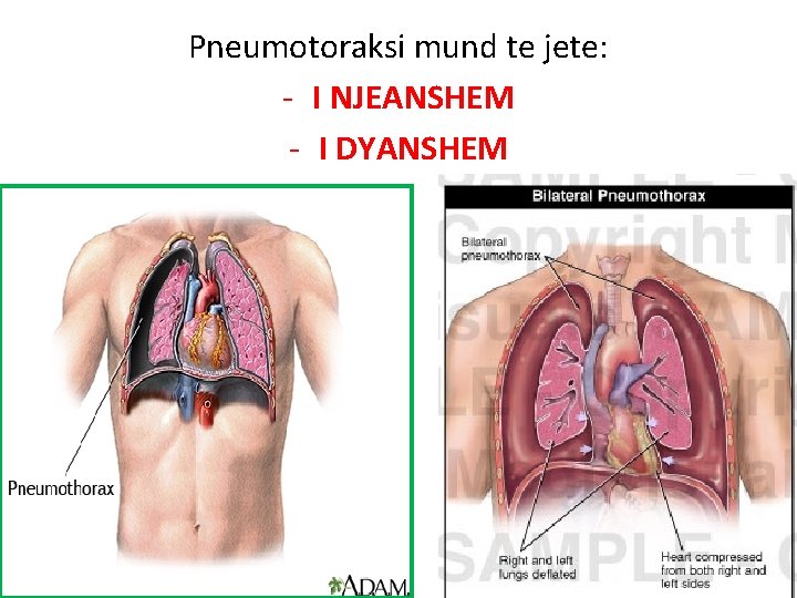 Pneumotoraksi mund te jete: - I NJEANSHEM - I DYANSHEM 