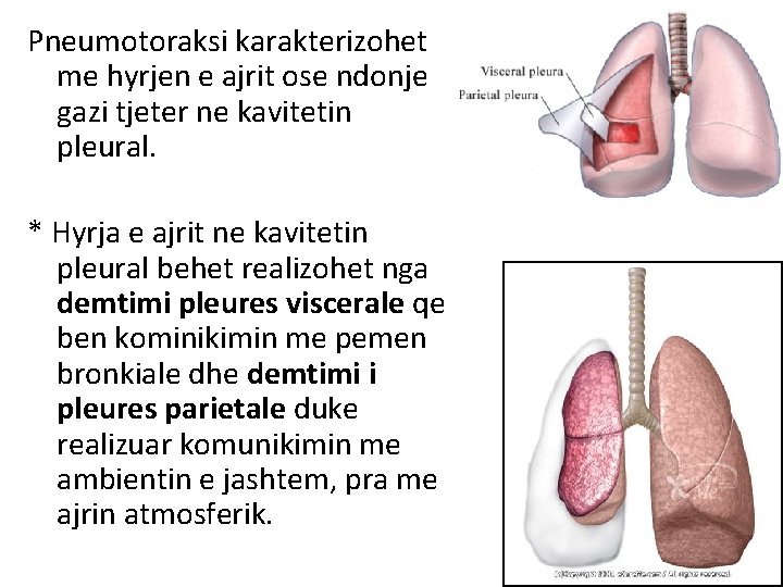 Pneumotoraksi karakterizohet me hyrjen e ajrit ose ndonje gazi tjeter ne kavitetin pleural. *