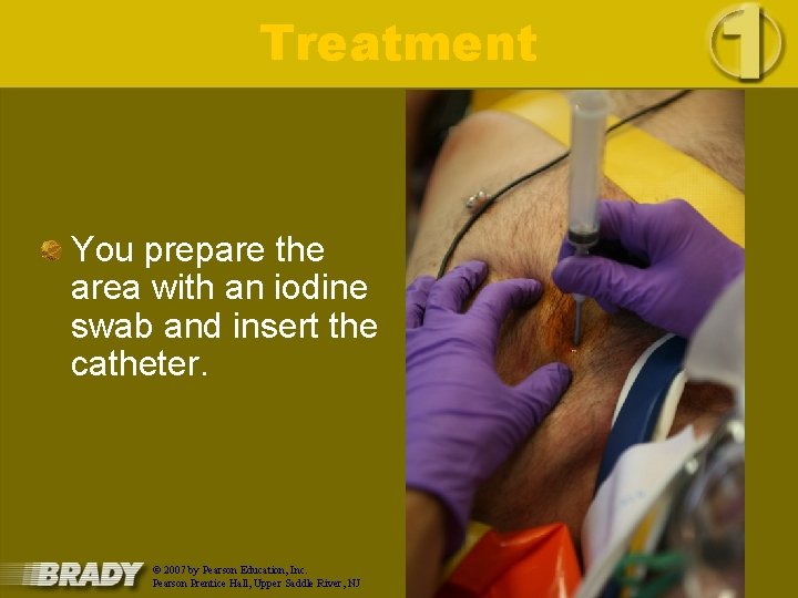 Treatment You prepare the area with an iodine swab and insert the catheter. ©