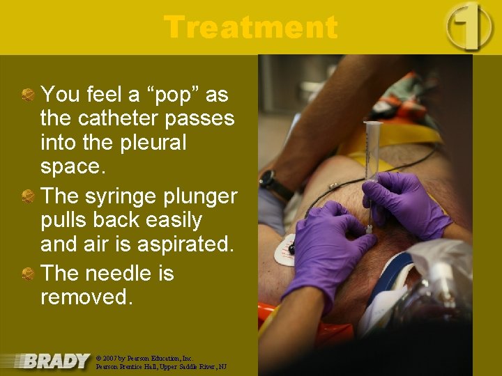 Treatment You feel a “pop” as the catheter passes into the pleural space. The