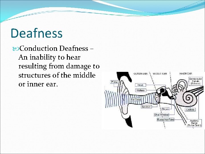 Deafness Conduction Deafness – An inability to hear resulting from damage to structures of