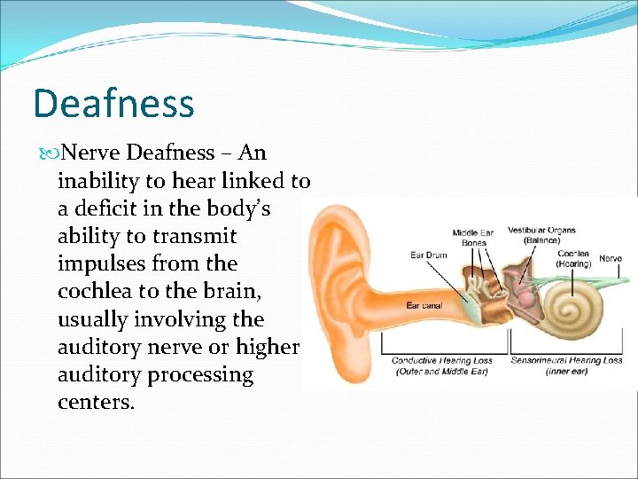 Deafness Nerve Deafness – An inability to hear linked to a deficit in the