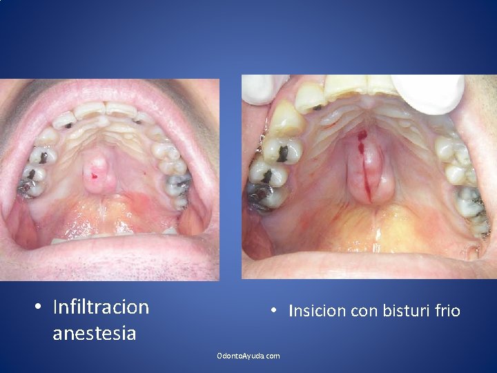  • Infiltracion anestesia • Insicion con bisturi frio Odonto. Ayuda. com 