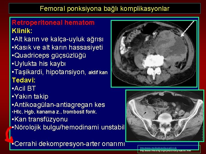 Femoral ponksiyona bağlı komplikasyonlar Retroperitoneal hematom Klinik: • Alt karın ve kalça-uyluk ağrısı •