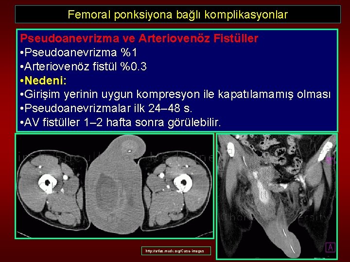 Femoral ponksiyona bağlı komplikasyonlar Pseudoanevrizma ve Arteriovenöz Fistüller • Pseudoanevrizma %1 • Arteriovenöz fistül