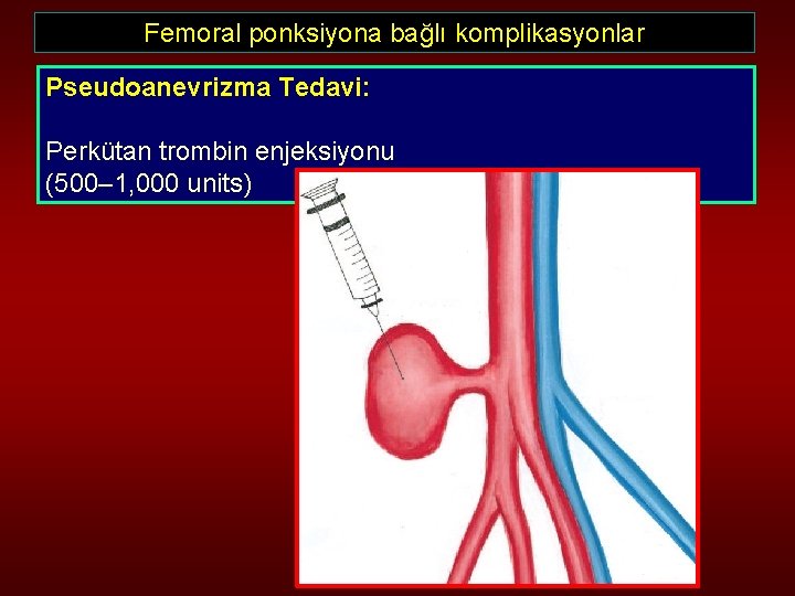 Femoral ponksiyona bağlı komplikasyonlar Pseudoanevrizma Tedavi: Perkütan trombin enjeksiyonu (500– 1, 000 units) 