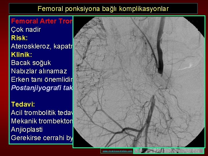 Femoral ponksiyona bağlı komplikasyonlar Femoral Arter Trombozu Çok nadir Risk: Ateroskleroz, kapatma cihazı, diseksiyon,