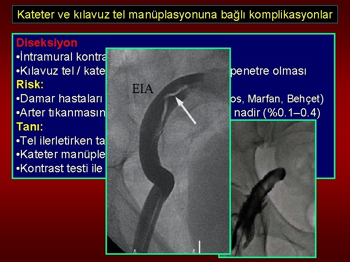 Kateter ve kılavuz tel manüplasyonuna bağlı komplikasyonlar Diseksiyon • İntramural kontrast enjeksiyonu • Kılavuz