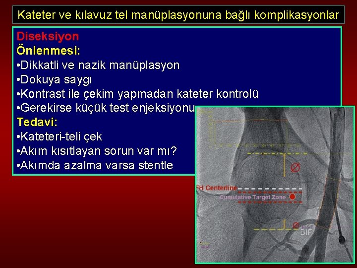 Kateter ve kılavuz tel manüplasyonuna bağlı komplikasyonlar Diseksiyon Önlenmesi: • Dikkatli ve nazik manüplasyon