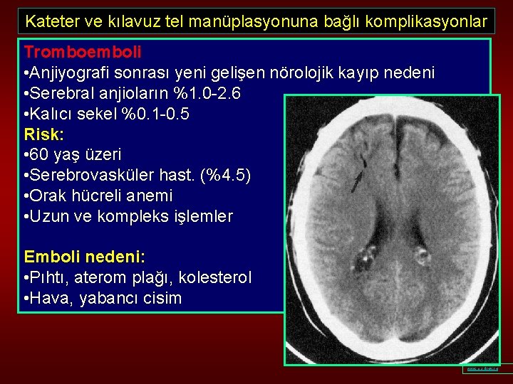 Kateter ve kılavuz tel manüplasyonuna bağlı komplikasyonlar Tromboemboli • Anjiyografi sonrası yeni gelişen nörolojik
