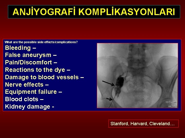 ANJİYOGRAFİ KOMPLİKASYONLARI What are the possible side effects/complications? Bleeding – False aneurysm – Pain/Discomfort