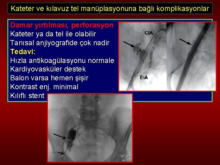 Kateter ve kılavuz tel manüplasyonuna bağlı komplikasyonlar Damar yırtılması, perforasyon Kateter ya da tel