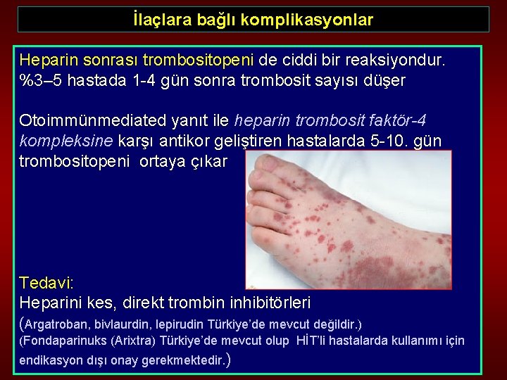 İlaçlara bağlı komplikasyonlar Heparin sonrası trombositopeni de ciddi bir reaksiyondur. %3– 5 hastada 1